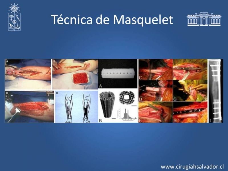 Diapositiva 26 de Reconstrucción de extremidad inferior