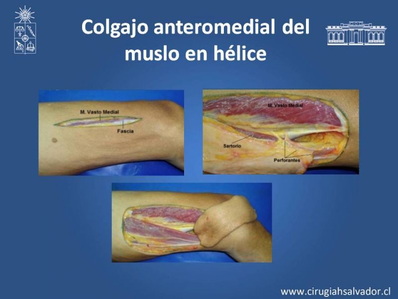 Diapositiva 19 de Reconstrucción de extremidad inferior