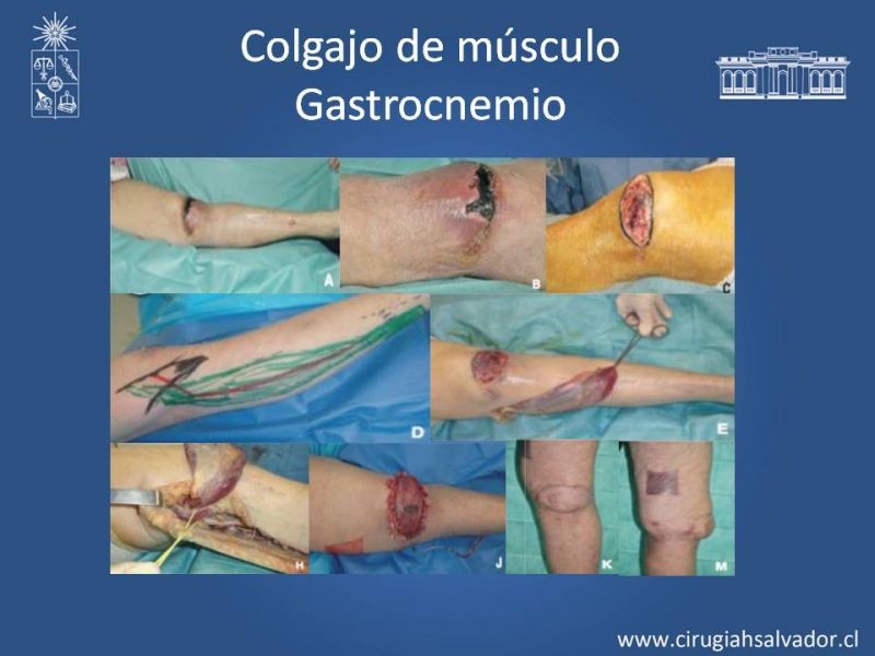 Diapositiva 14 de Reconstrucción de extremidad inferior