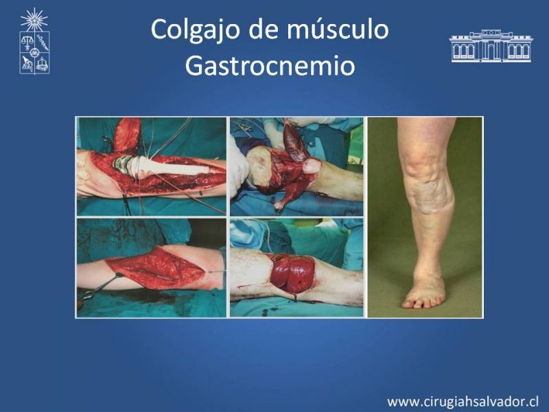 Diapositiva 15 de Reconstrucción de extremidad inferior