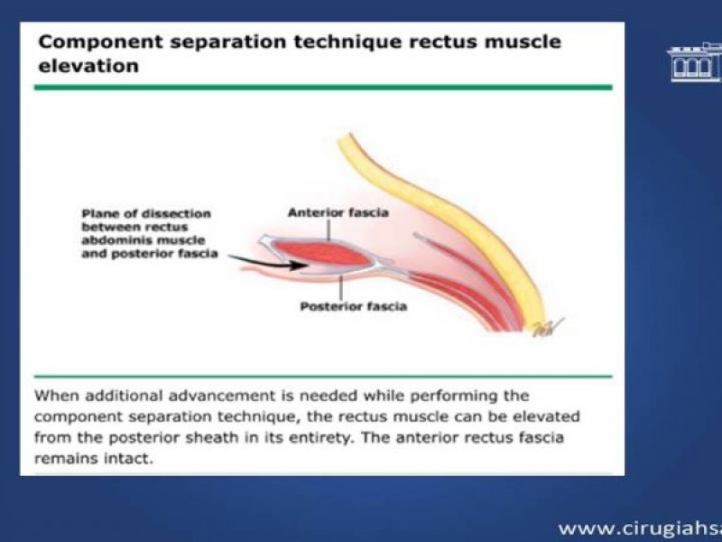 Diapositiva 20 de Cirugía de Separación de Componentes