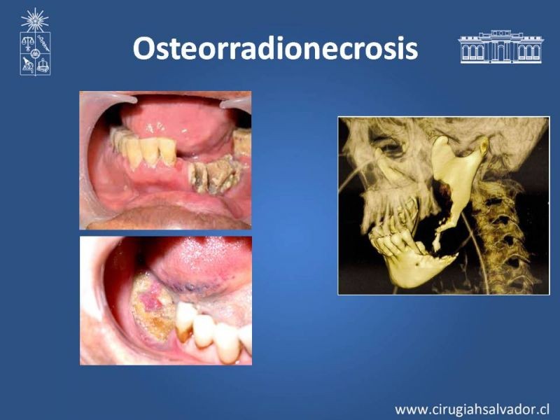 Diapositiva 19 de Complicaciones de la Radioterapia en  Cabeza y Cuello
