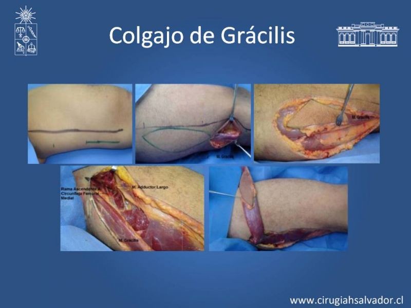 Diapositiva 22 de Reconstrucción de extremidad inferior
