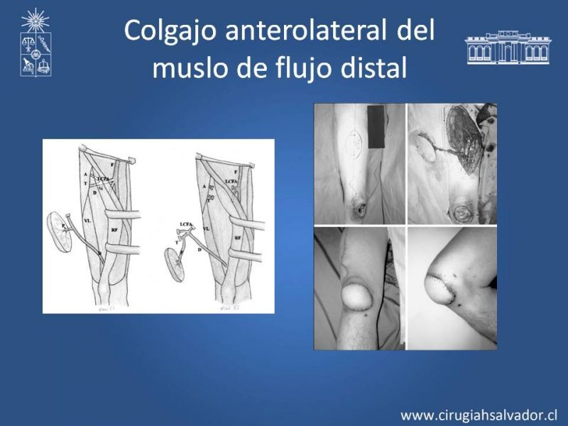 Diapositiva 17 de Reconstrucción de extremidad inferior