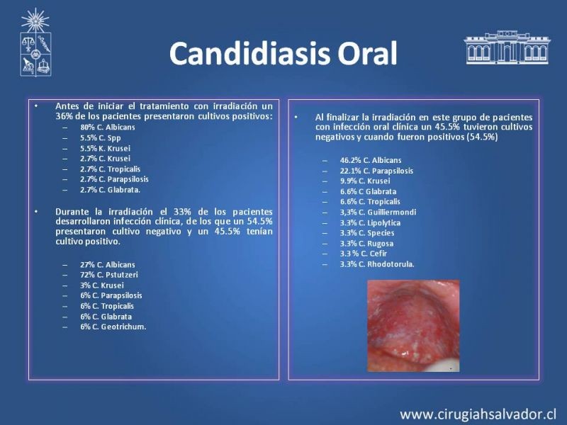 Diapositiva 16 de Complicaciones de la Radioterapia en  Cabeza y Cuello