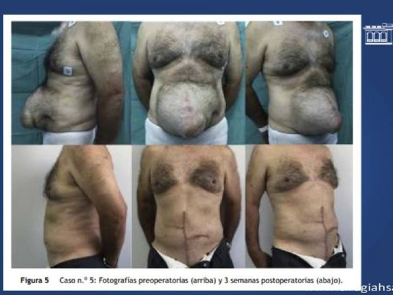 Diapositiva 45 de Cirugía de Separación de Componentes