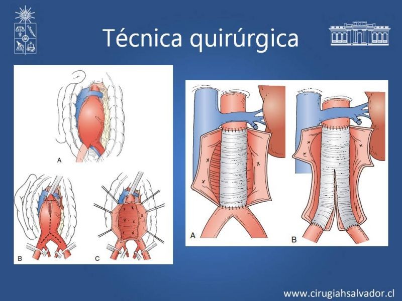 Diapositiva 18 de Aneurisma aórtico abdominal roto
