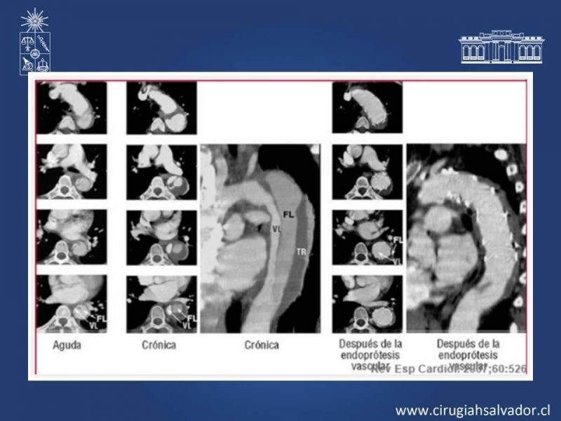Diapositiva 33 de Síndrome Aórtico Agudo