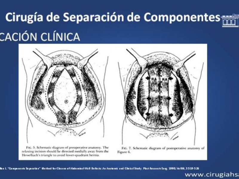 Diapositiva 13 de Cirugía de Separación de Componentes