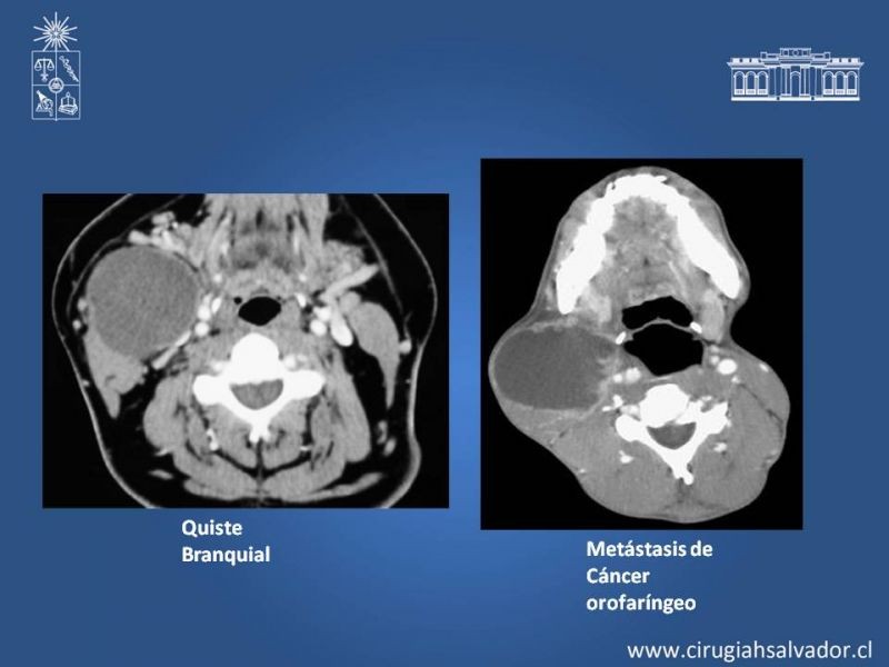 Diapositiva 18 de Quistes Branquiales
