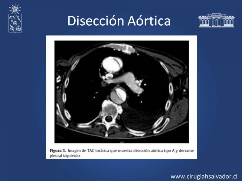 Diapositiva 8 de Síndrome Aórtico Agudo