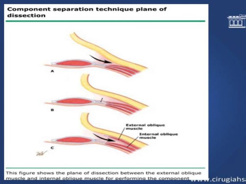Diapositiva 19 de Cirugía de Separación de Componentes