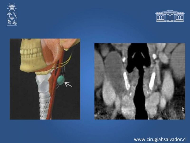 Diapositiva 24 de Quistes Branquiales