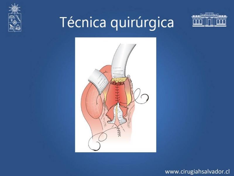 Diapositiva 19 de Aneurisma aórtico abdominal roto