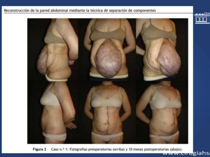 Diapositiva 43 de Cirugía de Separación de Componentes