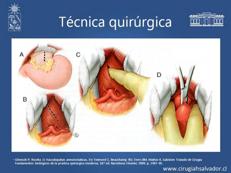 Diapositiva 14 de Aneurisma aórtico abdominal roto