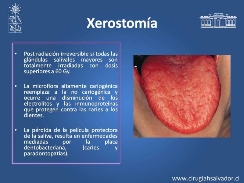 Diapositiva 9 de Complicaciones de la Radioterapia en  Cabeza y Cuello