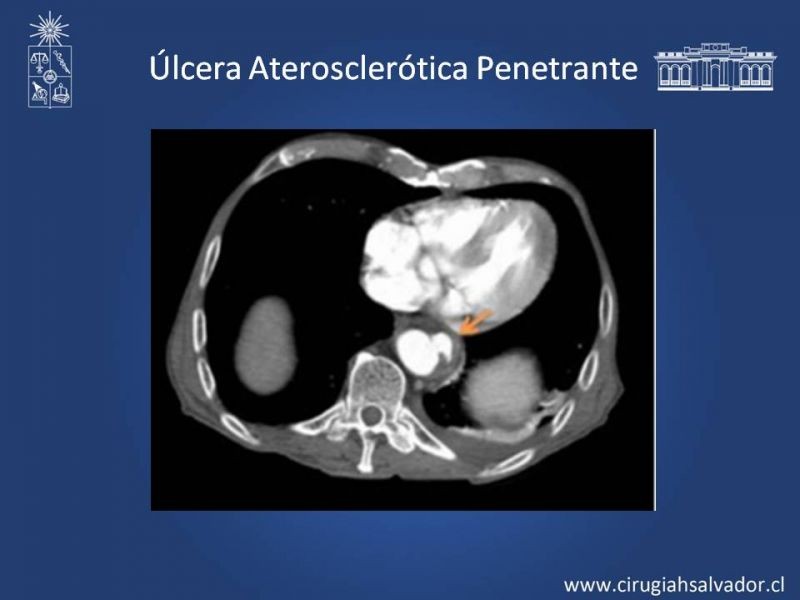 Diapositiva 12 de Síndrome Aórtico Agudo