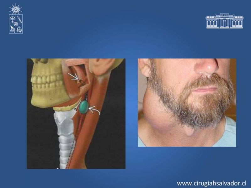Diapositiva 12 de Quistes Branquiales