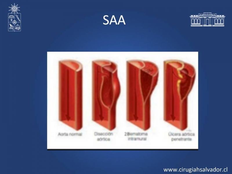 Diapositiva 6 de Síndrome Aórtico Agudo