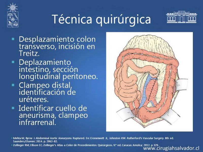 Diapositiva 15 de Aneurisma aórtico abdominal roto