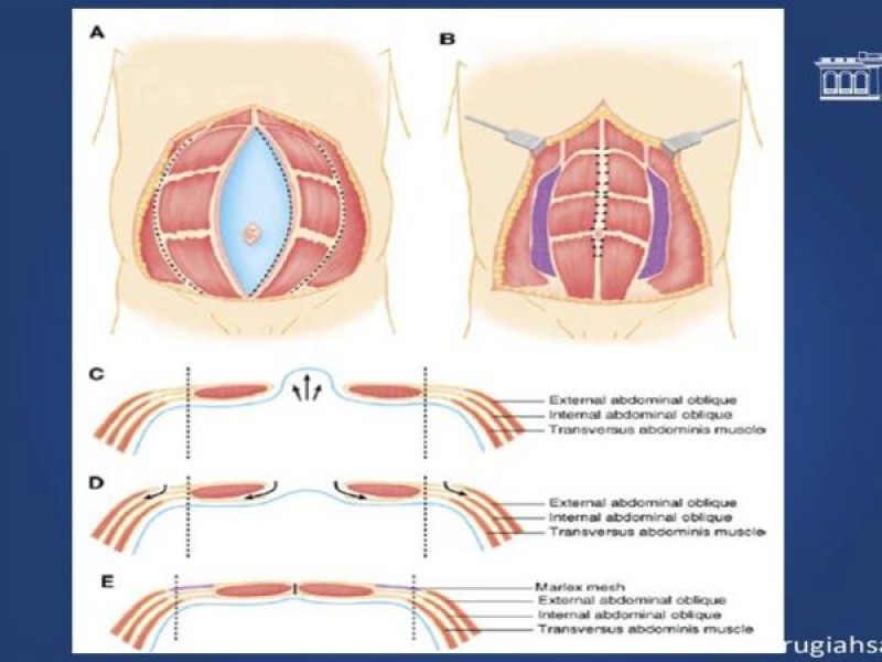 Diapositiva 26 de Cirugía de Separación de Componentes
