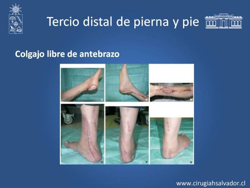 Diapositiva 32 de Reconstrucción de extremidad inferior
