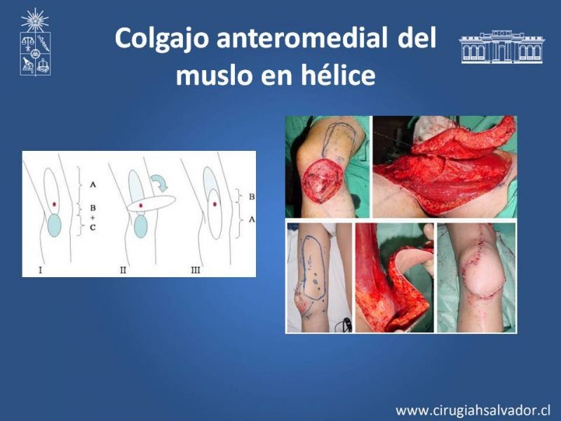 Diapositiva 20 de Reconstrucción de extremidad inferior