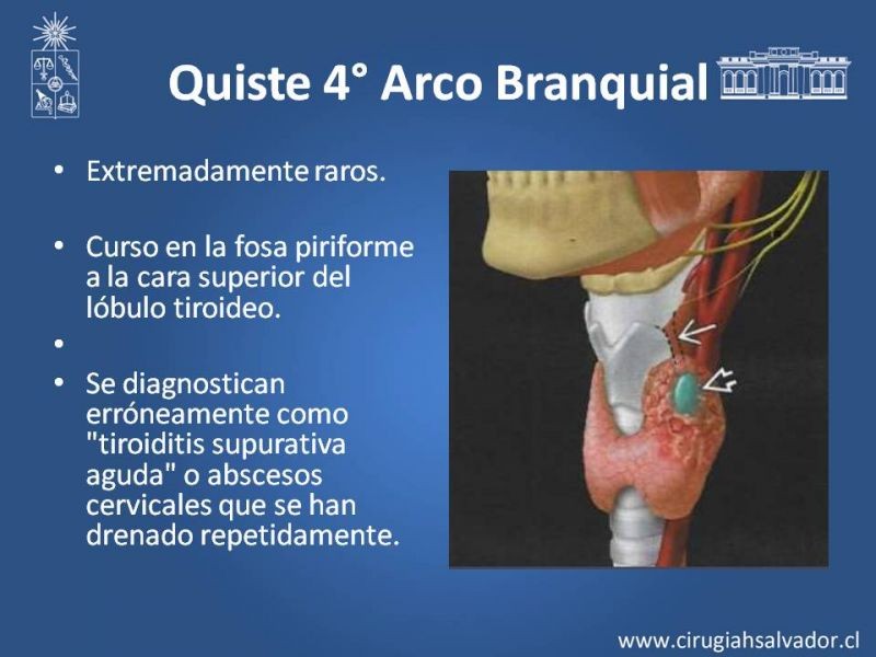 Diapositiva 28 de Quistes Branquiales