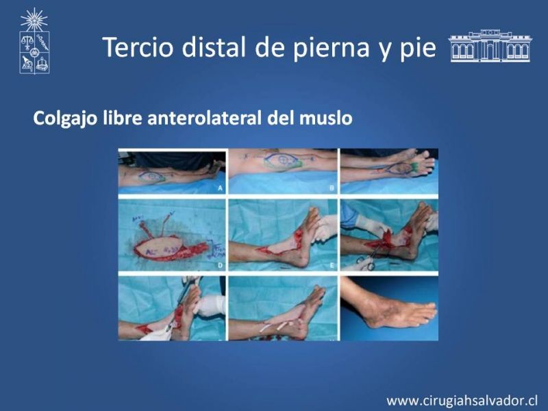 Diapositiva 31 de Reconstrucción de extremidad inferior