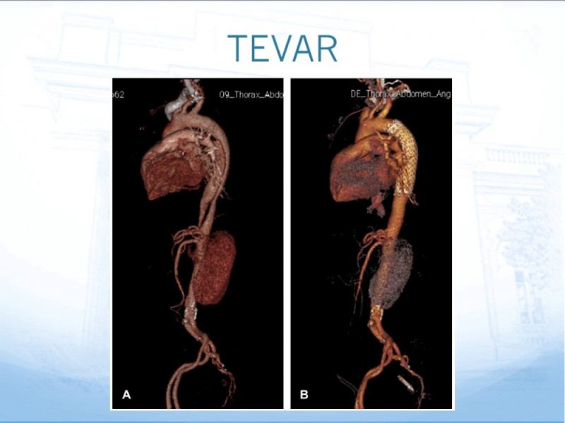 Diapositiva 16 de Manejo de disección aórtica tipo B