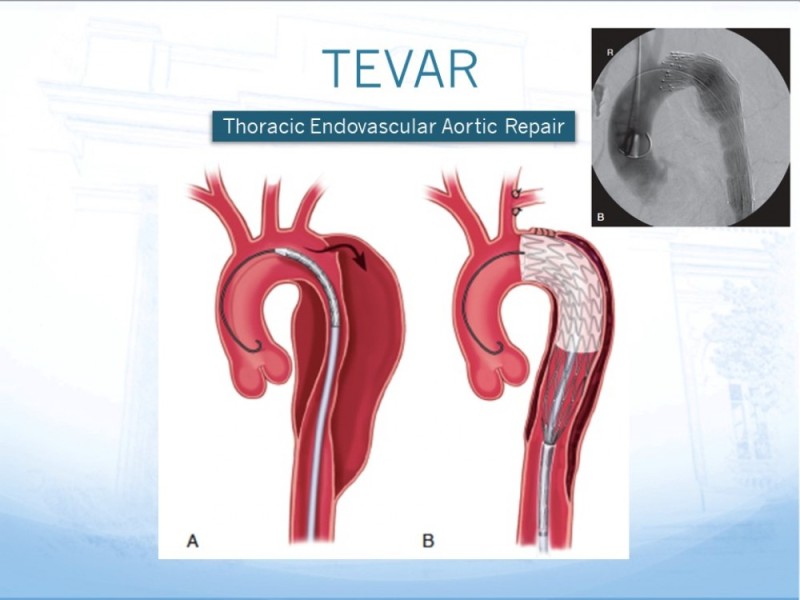 Diapositiva 15 de Manejo de disección aórtica tipo B