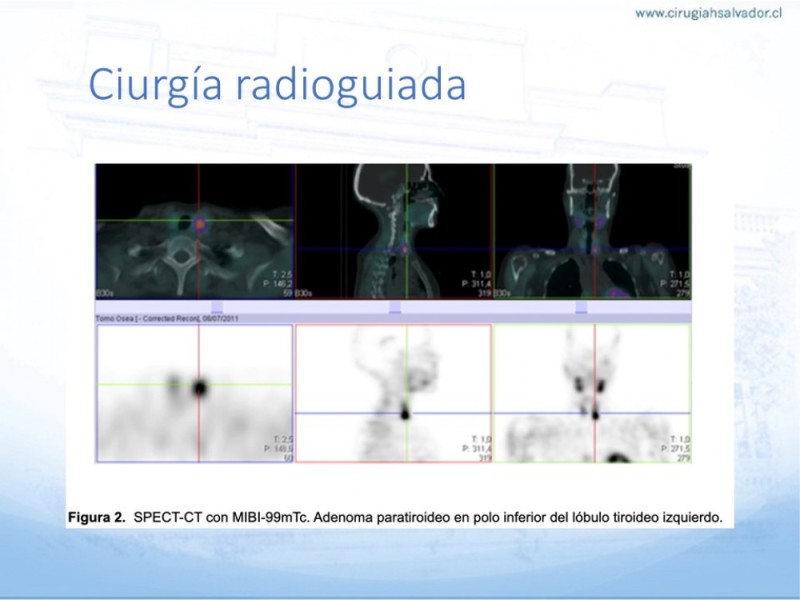 Diapositiva 25 de Hiperparatiroidismo primario