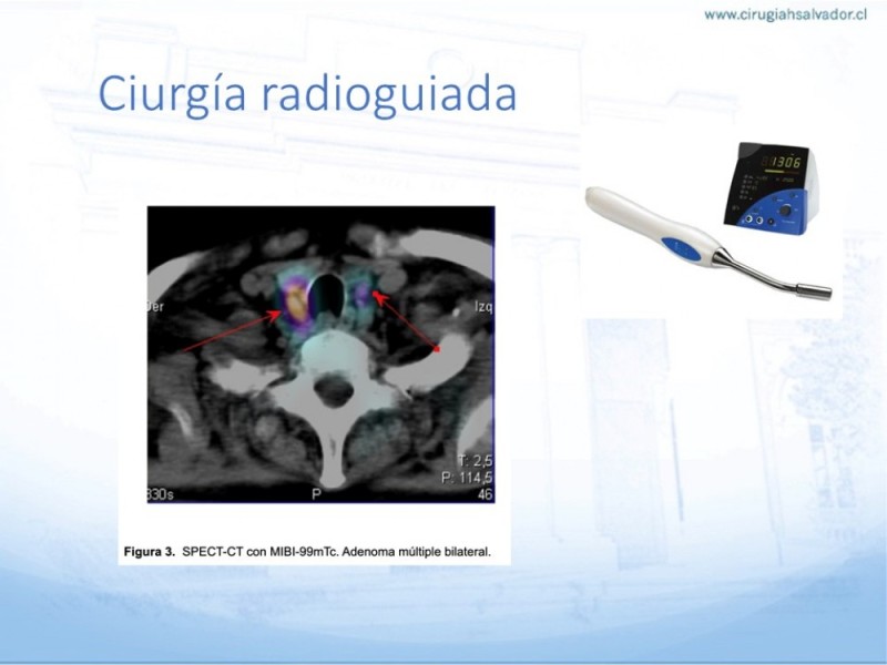 Diapositiva 24 de Hiperparatiroidismo primario