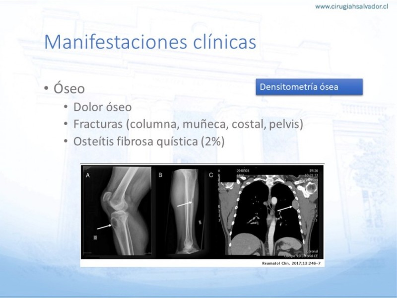 Diapositiva 15 de Hiperparatiroidismo primario