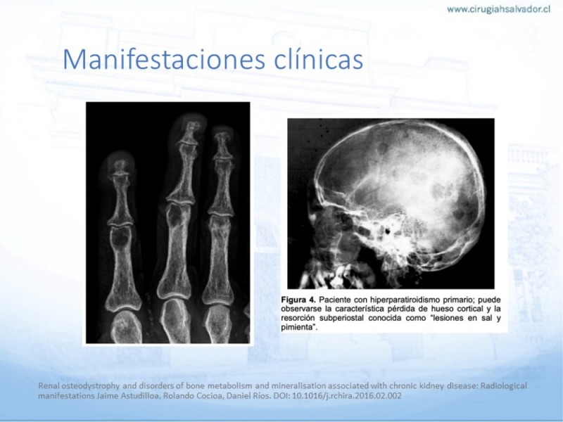 Diapositiva 16 de Hiperparatiroidismo primario