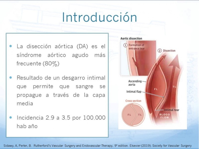 Diapositiva 1 de Manejo de disección aórtica tipo B