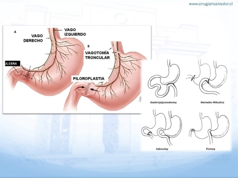 Diapositiva 11 de Sindrome de Retención Gástrica