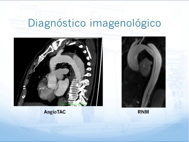 Diapositiva 9 de Manejo de disección aórtica tipo B