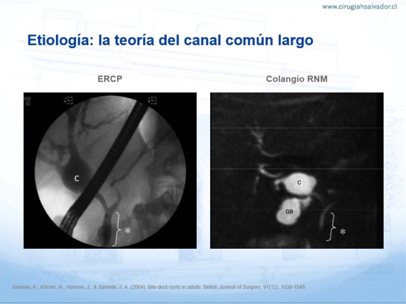 Diapositiva 8 de Quistes de Vía Biliar​