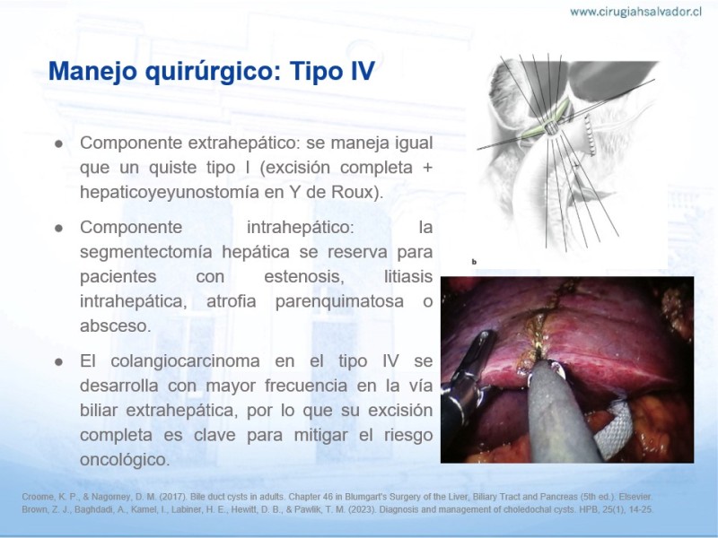 Diapositiva 18 de Quistes de Vía Biliar​