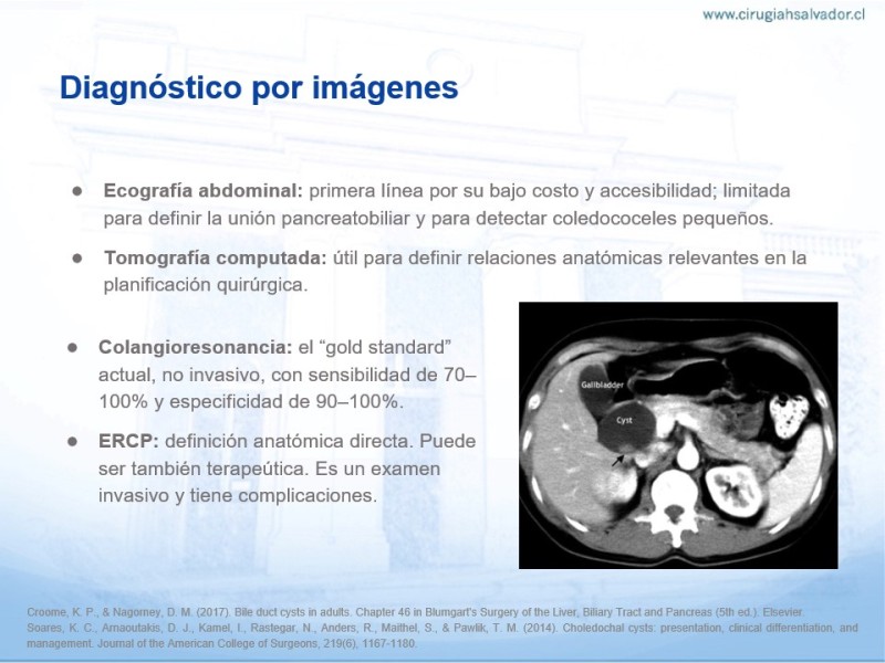 Diapositiva 11 de Quistes de Vía Biliar​