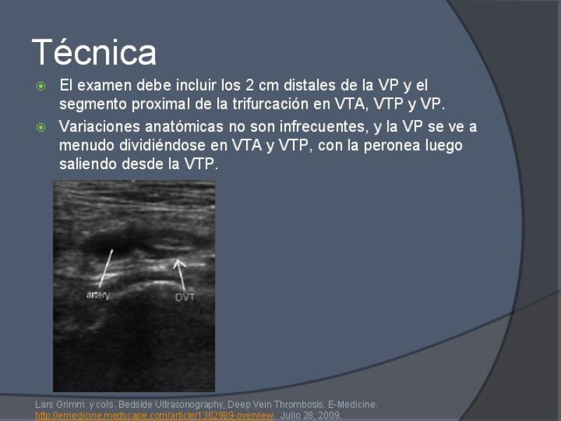 Diapositiva 12 de Ultrasonido de EEII en el diagnóstico de TVP