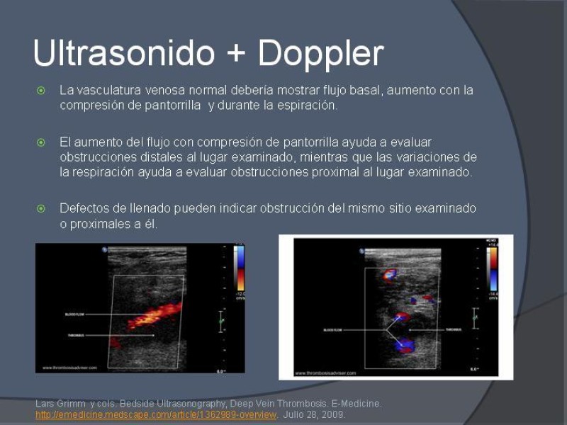 Diapositiva 14 de Ultrasonido de EEII en el diagnóstico de TVP