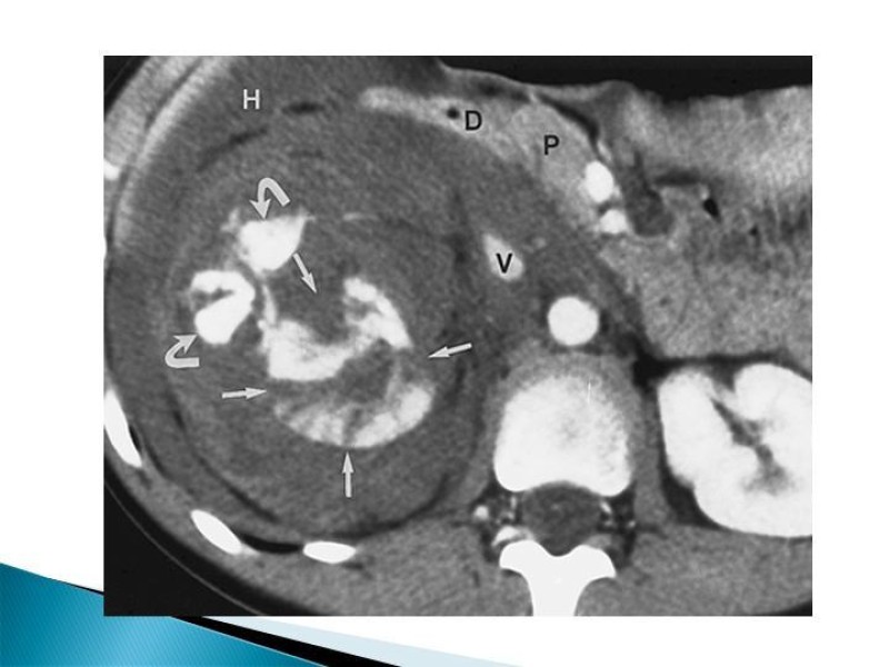 Diapositiva 9 de Trauma renal