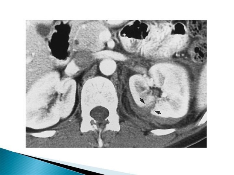 Diapositiva 12 de Trauma renal