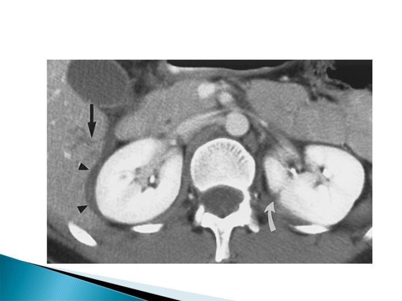 Diapositiva 11 de Trauma renal