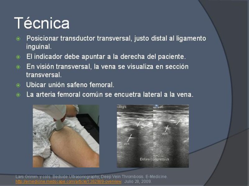 Diapositiva 8 de Ultrasonido de EEII en el diagnóstico de TVP