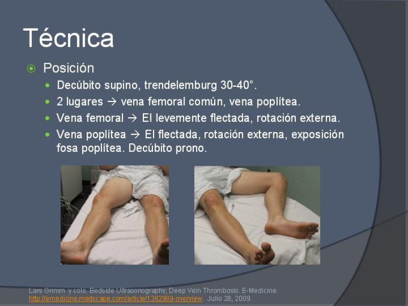 Diapositiva 6 de Ultrasonido de EEII en el diagnóstico de TVP