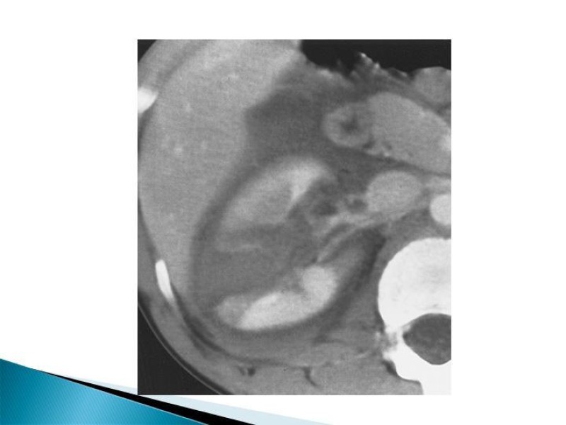 Diapositiva 10 de Trauma renal
